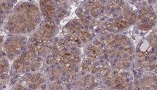 OR2W1 Antibody - 1:100 staining human liver carcinoma tissues by IHC-P. The sample was formaldehyde fixed and a heat mediated antigen retrieval step in citrate buffer was performed. The sample was then blocked and incubated with the antibody for 1.5 hours at 22°C. An HRP conjugated goat anti-rabbit antibody was used as the secondary.