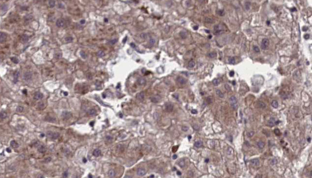 OR4C45 Antibody - 1:100 staining human liver carcinoma tissues by IHC-P. The sample was formaldehyde fixed and a heat mediated antigen retrieval step in citrate buffer was performed. The sample was then blocked and incubated with the antibody for 1.5 hours at 22°C. An HRP conjugated goat anti-rabbit antibody was used as the secondary.