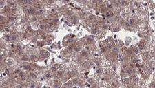 OR4C45 Antibody - 1:100 staining human liver carcinoma tissues by IHC-P. The sample was formaldehyde fixed and a heat mediated antigen retrieval step in citrate buffer was performed. The sample was then blocked and incubated with the antibody for 1.5 hours at 22°C. An HRP conjugated goat anti-rabbit antibody was used as the secondary.