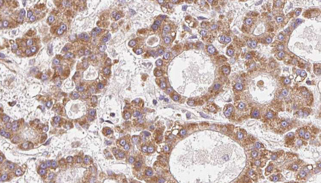 OR4N2 Antibody - 1:100 staining human liver carcinoma tissues by IHC-P. The sample was formaldehyde fixed and a heat mediated antigen retrieval step in citrate buffer was performed. The sample was then blocked and incubated with the antibody for 1.5 hours at 22°C. An HRP conjugated goat anti-rabbit antibody was used as the secondary.