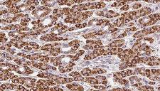 OR51F2 Antibody - 1:100 staining human liver carcinoma tissues by IHC-P. The sample was formaldehyde fixed and a heat mediated antigen retrieval step in citrate buffer was performed. The sample was then blocked and incubated with the antibody for 1.5 hours at 22°C. An HRP conjugated goat anti-rabbit antibody was used as the secondary.