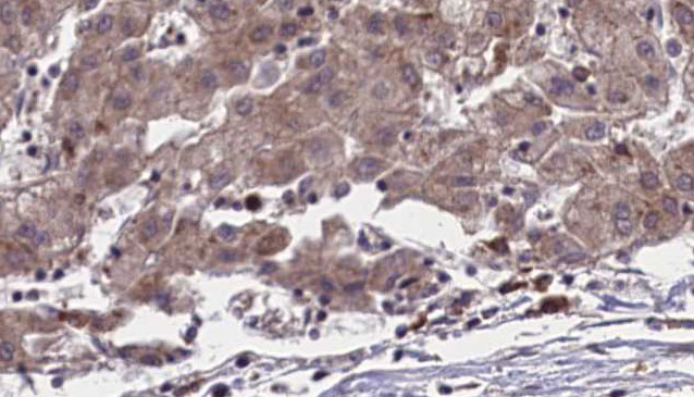 OR51L1 Antibody - 1:100 staining human liver carcinoma tissues by IHC-P. The sample was formaldehyde fixed and a heat mediated antigen retrieval step in citrate buffer was performed. The sample was then blocked and incubated with the antibody for 1.5 hours at 22°C. An HRP conjugated goat anti-rabbit antibody was used as the secondary.