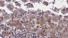 OR51M1 Antibody - 1:100 staining human liver carcinoma tissues by IHC-P. The sample was formaldehyde fixed and a heat mediated antigen retrieval step in citrate buffer was performed. The sample was then blocked and incubated with the antibody for 1.5 hours at 22°C. An HRP conjugated goat anti-rabbit antibody was used as the secondary.