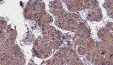OR52H1 Antibody - 1:100 staining human liver carcinoma tissues by IHC-P. The sample was formaldehyde fixed and a heat mediated antigen retrieval step in citrate buffer was performed. The sample was then blocked and incubated with the antibody for 1.5 hours at 22°C. An HRP conjugated goat anti-rabbit antibody was used as the secondary.