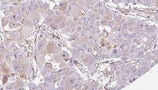 OR52J3 Antibody - 1:100 staining human liver carcinoma tissues by IHC-P. The sample was formaldehyde fixed and a heat mediated antigen retrieval step in citrate buffer was performed. The sample was then blocked and incubated with the antibody for 1.5 hours at 22°C. An HRP conjugated goat anti-rabbit antibody was used as the secondary.