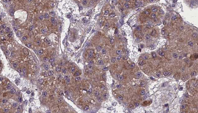 OR52K2 Antibody - 1:100 staining human liver carcinoma tissues by IHC-P. The sample was formaldehyde fixed and a heat mediated antigen retrieval step in citrate buffer was performed. The sample was then blocked and incubated with the antibody for 1.5 hours at 22°C. An HRP conjugated goat anti-rabbit antibody was used as the secondary.