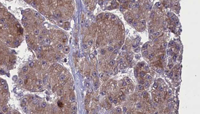 OR52N2 Antibody - 1:100 staining human liver carcinoma tissues by IHC-P. The sample was formaldehyde fixed and a heat mediated antigen retrieval step in citrate buffer was performed. The sample was then blocked and incubated with the antibody for 1.5 hours at 22°C. An HRP conjugated goat anti-rabbit antibody was used as the secondary.