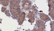 OR52N5 Antibody - 1:100 staining human liver carcinoma tissues by IHC-P. The sample was formaldehyde fixed and a heat mediated antigen retrieval step in citrate buffer was performed. The sample was then blocked and incubated with the antibody for 1.5 hours at 22°C. An HRP conjugated goat anti-rabbit antibody was used as the secondary.