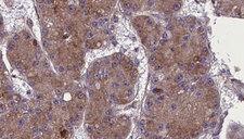 OR52R1 Antibody - 1:100 staining human liver carcinoma tissues by IHC-P. The sample was formaldehyde fixed and a heat mediated antigen retrieval step in citrate buffer was performed. The sample was then blocked and incubated with the antibody for 1.5 hours at 22°C. An HRP conjugated goat anti-rabbit antibody was used as the secondary.