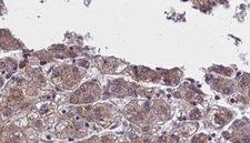 OR5AN1 Antibody - 1:100 staining human liver carcinoma tissues by IHC-P. The sample was formaldehyde fixed and a heat mediated antigen retrieval step in citrate buffer was performed. The sample was then blocked and incubated with the antibody for 1.5 hours at 22°C. An HRP conjugated goat anti-rabbit antibody was used as the secondary.