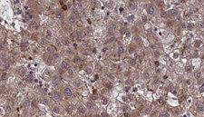 OR7E24 Antibody - 1:100 staining human liver carcinoma tissues by IHC-P. The sample was formaldehyde fixed and a heat mediated antigen retrieval step in citrate buffer was performed. The sample was then blocked and incubated with the antibody for 1.5 hours at 22°C. An HRP conjugated goat anti-rabbit antibody was used as the secondary.