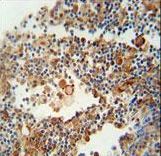 OR9Q1 Antibody - OR9Q1 antibody immunohistochemistry of formalin-fixed and paraffin-embedded human lung carcinoma followed by peroxidase-conjugated secondary antibody and DAB staining.