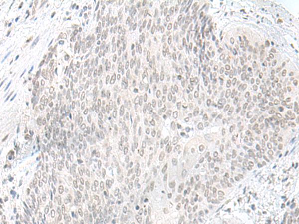 ORC1 Antibody - Immunohistochemistry of paraffin-embedded Human esophagus cancer tissue  using ORC1 Polyclonal Antibody at dilution of 1:65(×200)