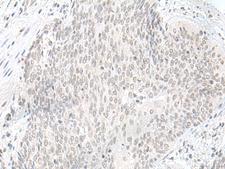 ORC1 Antibody - Immunohistochemistry of paraffin-embedded Human esophagus cancer tissue  using ORC1 Polyclonal Antibody at dilution of 1:65(×200)