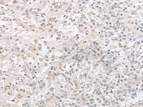 ORC1 Antibody - Immunohistochemistry of paraffin-embedded Human liver cancer tissue  using ORC1 Polyclonal Antibody at dilution of 1:65(×200)