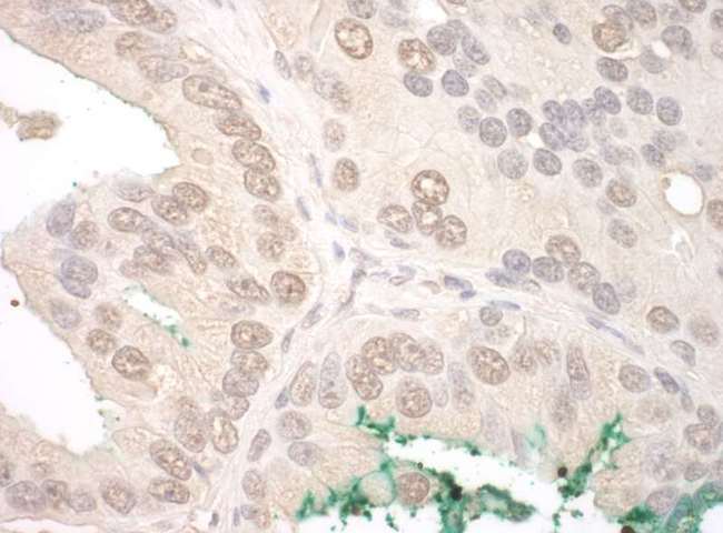 ORC2L / ORC2 Antibody - Detection of Human ORC2 by Immunohistochemistry. Sample: FFPE section of human prostate carcinoma. Antibody: Affinity purified rabbit anti-ORC2 used at a dilution of 1:1000 (0.2 ug/mg).