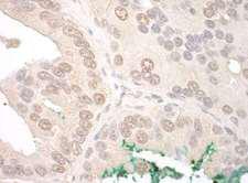 ORC2L / ORC2 Antibody - Detection of Human ORC2 by Immunohistochemistry. Sample: FFPE section of human prostate carcinoma. Antibody: Affinity purified rabbit anti-ORC2 used at a dilution of 1:1000 (0.2 ug/mg).