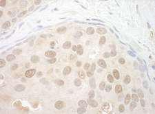 ORC2L / ORC2 Antibody - Detection of Human ORC2 by Immunohistochemistry. Sample: FFPE section of human breast carcinoma. Antibody: Affinity purified rabbit anti-ORC2 used at a dilution of 1:200 (1 ug/mg).
