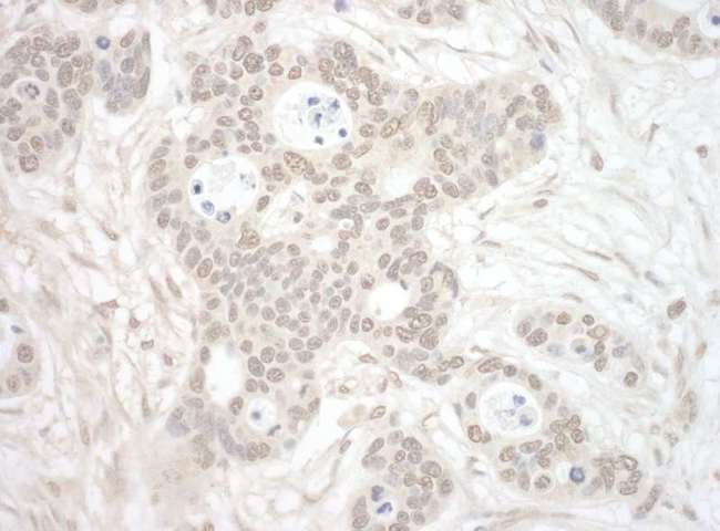 ORC3L / ORC3 Antibody - Detection of Human ORC3 by Immunohistochemistry. Sample: FFPE section of human breast carcinoma. Antibody: Affinity purified rabbit anti-ORC3 used at a dilution of 1:200 (1 ug/mg).