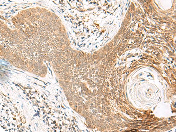 ORC4L / ORC4 Antibody - Immunohistochemistry of paraffin-embedded Human esophagus cancer tissue  using ORC4 Polyclonal Antibody at dilution of 1:80(×200)