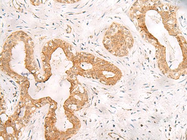 ORC4L / ORC4 Antibody - Immunohistochemistry of paraffin-embedded Human breast cancer tissue  using ORC4 Polyclonal Antibody at dilution of 1:80(×200)