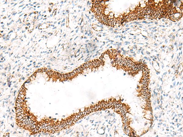 ORC4L / ORC4 Antibody - Immunohistochemistry of paraffin-embedded Human cervical cancer tissue  using ORC4 Polyclonal Antibody at dilution of 1:70(×200)