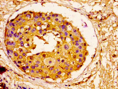ORM1 / Orosomucoid Antibody - IHC image of ORM1 Antibody diluted at 1:100 and staining in paraffin-embedded human breast cancer performed on a Leica BondTM system. After dewaxing and hydration, antigen retrieval was mediated by high pressure in a citrate buffer (pH 6.0). Section was blocked with 10% normal goat serum 30min at RT. Then primary antibody (1% BSA) was incubated at 4°C overnight. The primary is detected by a biotinylated secondary antibody and visualized using an HRP conjugated SP system.