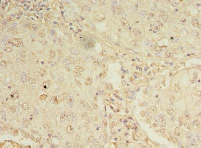ORMDL1 Antibody - Immunohistochemistry of paraffin-embedded human lung cancer using antibody at dilution of 1:100.