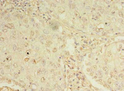 ORMDL1 Antibody - Immunohistochemistry of paraffin-embedded human lung cancer using ORMDL1 Antibody at dilution of 1:100