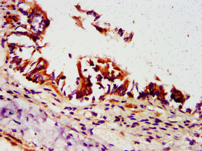 ORMDL3 Antibody - Immunohistochemistry image at a dilution of 1:500 and staining in paraffin-embedded human lung tissue performed on a Leica BondTM system. After dewaxing and hydration, antigen retrieval was mediated by high pressure in a citrate buffer (pH 6.0) . Section was blocked with 10% normal goat serum 30min at RT. Then primary antibody (1% BSA) was incubated at 4 °C overnight. The primary is detected by a biotinylated secondary antibody and visualized using an HRP conjugated SP system.