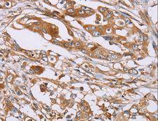OS9 Antibody - Immunohistochemistry of paraffin-embedded Human colon cancer using OS9 Polyclonal Antibody at dilution of 1:30.