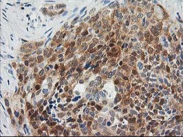 OSBP Antibody - IHC of paraffin-embedded Adenocarcinoma of Human breast tissue using anti-OSBP mouse monoclonal antibody. (Heat-induced epitope retrieval by 10mM citric buffer, pH6.0, 100C for 10min).