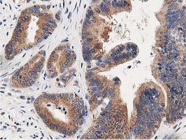 OSBP Antibody - IHC of paraffin-embedded Adenocarcinoma of Human colon tissue using anti-OSBP mouse monoclonal antibody. (Heat-induced epitope retrieval by 10mM citric buffer, pH6.0, 100C for 10min).