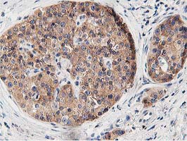 OSBP Antibody - IHC of paraffin-embedded Carcinoma of Human pancreas tissue using anti-OSBP mouse monoclonal antibody. (Heat-induced epitope retrieval by 10mM citric buffer, pH6.0, 100C for 10min).