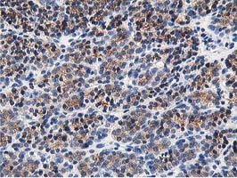 OSBP Antibody - IHC of paraffin-embedded Carcinoma of Human thyroid tissue using anti-OSBP mouse monoclonal antibody. (Heat-induced epitope retrieval by 10mM citric buffer, pH6.0, 100C for 10min).