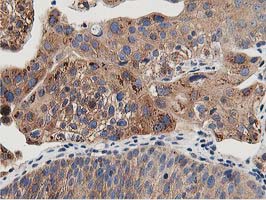 OSBP Antibody - IHC of paraffin-embedded Carcinoma of Human bladder tissue using anti-OSBP mouse monoclonal antibody. (Heat-induced epitope retrieval by 10mM citric buffer, pH6.0, 100C for 10min).