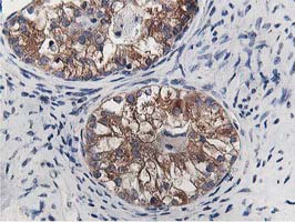 OSBP Antibody - IHC of paraffin-embedded Adenocarcinoma of Human ovary tissue using anti-OSBP mouse monoclonal antibody. (Heat-induced epitope retrieval by 10mM citric buffer, pH6.0, 100C for 10min).