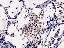 OSBPL11 Antibody - IHC of paraffin-embedded Carcinoma of Human lung tissue using anti-OSBPL11 mouse monoclonal antibody.