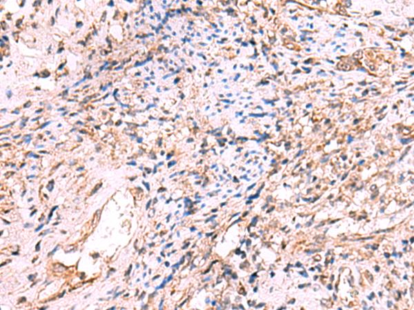 OSBPL2 Antibody - Immunohistochemistry of paraffin-embedded Human cervical cancer tissue  using OSBPL2 Polyclonal Antibody at dilution of 1:55(×200)