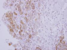 OSBPL5 Antibody - IHC of paraffin-embedded Breast ca, using OSBPL5 antibody at 1:500 dilution.