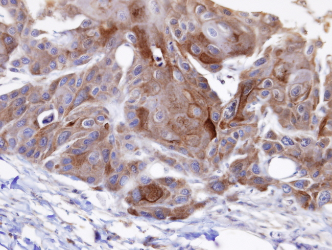 OSBPL6 Antibody - IHC of paraffin-embedded SCC15 xenograft using OSBPL6 antibody at 1:100 dilution.