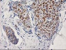 OSGEP Antibody - IHC of paraffin-embedded Adenocarcinoma of Human breast tissue using anti-OSGEP mouse monoclonal antibody.