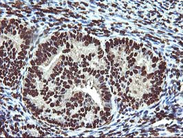OSGEP Antibody - IHC of paraffin-embedded Adenocarcinoma of Human endometrium tissue using anti-OSGEP mouse monoclonal antibody.
