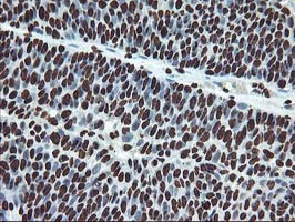 OSGEP Antibody - IHC of paraffin-embedded Carcinoma of Human bladder tissue using anti-OSGEP mouse monoclonal antibody.