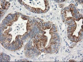 OSGEP Antibody - IHC of paraffin-embedded Adenocarcinoma of Human colon tissue using anti-OSGEP mouse monoclonal antibody.