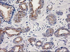OSGEP Antibody - IHC of paraffin-embedded Carcinoma of Human prostate tissue using anti-OSGEP mouse monoclonal antibody.