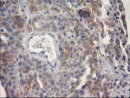 OSGEP Antibody - IHC of paraffin-embedded Carcinoma of Human bladder tissue using anti-OSGEP mouse monoclonal antibody.