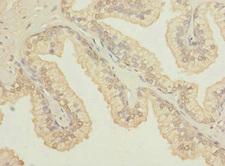 OSGEPL1 Antibody - Immunohistochemistry of paraffin-embedded human prostate cancer at dilution 1:100