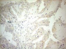 OSGIN2 Antibody - Immunohistochemical staining of paraffin-embedded Carcinoma of Human thyroid tissue using anti-OSGIN2 mouse monoclonal antibody. (Heat-induced epitope retrieval by 1mM EDTA in 10mM Tris buffer. (pH8.5) at 120°C for 3 min. (1:150)