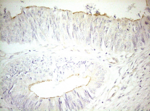 OSGIN2 Antibody - Immunohistochemical staining of paraffin-embedded Adenocarcinoma of Human colon tissue using anti-OSGIN2 mouse monoclonal antibody. (Heat-induced epitope retrieval by 1mM EDTA in 10mM Tris buffer. (pH8.5) at 120°C for 3 min. (1:150)